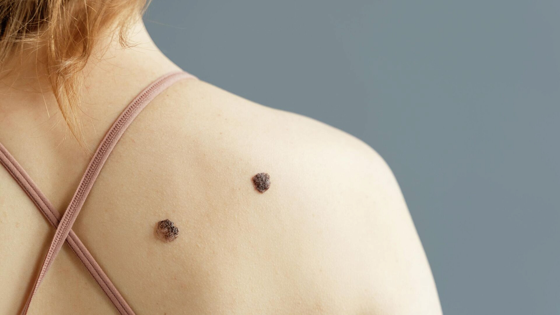 Врачи назвали популярную привычку, серьезно повышающую риск развития рака