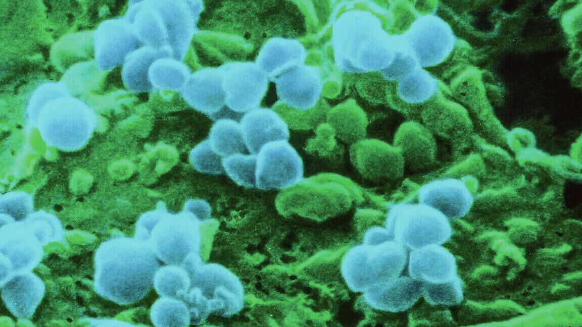 Число заболевших корью в Техасе достигло 561