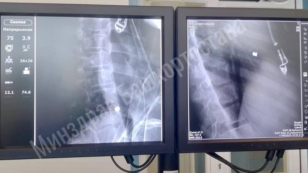 В Башкирии врачи спасли девочку с пулевым ранением сердца