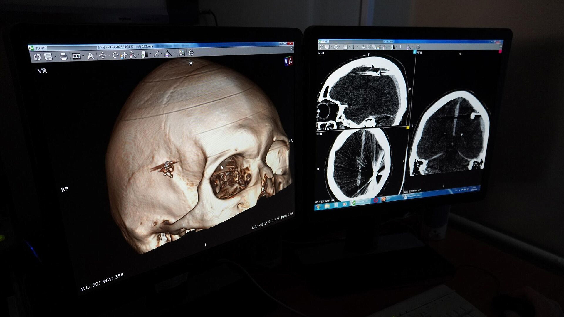Алтайские врачи спасли пациента, который сутки ходил с пулей в голове