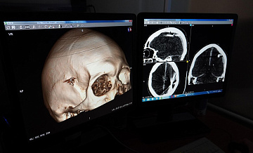 Алтайские врачи спасли пациента, который сутки ходил с пулей в голове